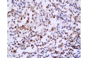 Formalin-fixed and paraffin embedded: human endometrium carcinoma labeled with Anti-Caspase-6 Polyclonal Antibody , Unconjugated 1:200 followed by conjugation to the secondary antibody and DAB staining