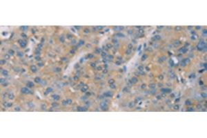 Immunohistochemistry of paraffin-embedded Human liver cancer tissue using ZBTB6 Polyclonal Antibody at dilution of 1:50(x200)