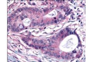 Affinity Purified Plk1 pT210 was used at a 1:200 dilution to detect Plk1 by immunohistochemistry in human colon carcinoma tumor tissue.