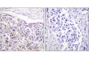 Immunohistochemistry analysis of paraffin-embedded human breast carcinoma, using p90 RSK (Phospho-Thr573) Antibody.