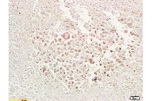 Formalin-fixed and paraffin embedded mouse tumor tissue labeled with Anti-TRAF1 Polyclonal Antibody, Unconjugated (ABIN673464) at 1:200 followed by conjugation to the secondary antibody and DAB staining.