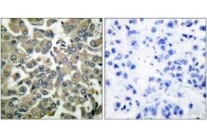Immunohistochemistry analysis of paraffin-embedded human breast carcinoma, using WNK1 (Phospho-Thr58) Antibody.