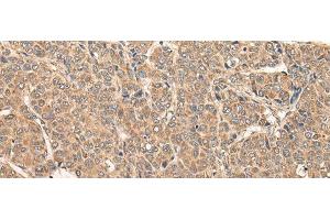Immunohistochemistry of paraffin-embedded Human liver cancer tissue using RCAN3 Polyclonal Antibody at dilution of 1:60(x200)