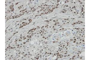 IHC-P Image Immunohistochemical analysis of paraffin-embedded oral CA cell lines Ca922 xenograft, using BCL7A, antibody at 1:100 dilution.