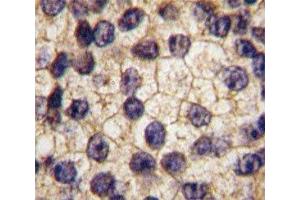 IHC analysis of FFPE human prostate carcinoma tissue stained with PDGFR alpha antibody