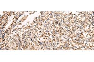 Immunohistochemistry of paraffin-embedded Human lung cancer tissue using NDUFB11 Polyclonal Antibody at dilution of 1:95(x200)