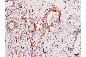Formalin-fixed and paraffin embedded human breast cancer labeled with Anti-CA153/MUC1/KL-6 Polyclonal Antibody, Unconjugated (ABIN687367) at 1:200 followed by conjugation to the secondary antibody and DAB staining.