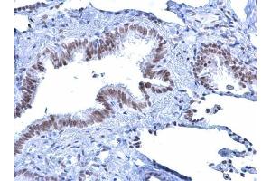 IHC-P Image Rad54 antibody [C3], C-term detects Rad54 protein at nucleus on human lung carcinoma by immunohistochemical analysis.