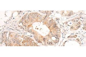 Immunohistochemistry of paraffin-embedded Human colorectal cancer tissue using HTRA1 Polyclonal Antibody at dilution of 1:55(x200)