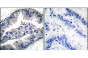 Immunohistochemistry analysis of paraffin-embedded human lung carcinoma, using BIK (Phospho-Thr33) Antibody.