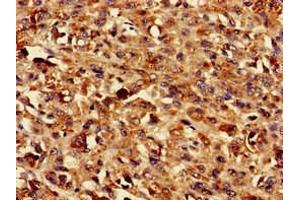 Immunohistochemistry of paraffin-embedded human melanoma using ABIN7173215 at dilution of 1:100