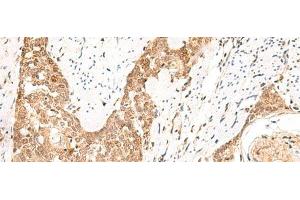 Immunohistochemistry of paraffin-embedded Human esophagus cancer tissue using PPP1R3C Polyclonal Antibody at dilution of 1:50(x200)