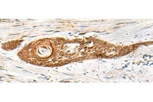 Immunohistochemistry of paraffin-embedded Human esophagus cancer tissue using GPSM1 Polyclonal Antibody at dilution of 1:85(x200)