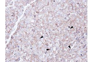 IHC-P Image Immunohistochemical analysis of paraffin-embedded CL1-0 xenograft, using SCARA3, antibody at 1:100 dilution.