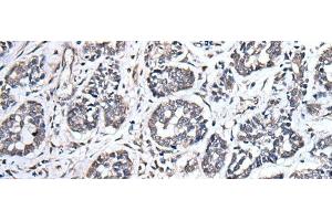 Immunohistochemistry of paraffin-embedded Human esophagus cancer tissue using UBE2E3 Polyclonal Antibody at dilution of 1:40(x200)