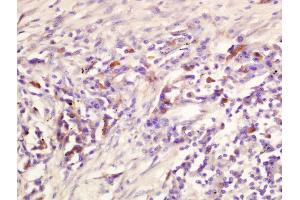 Formalin-fixed and paraffin embedded human lung carcinoma labeled with Rabbit Anti-ADORA2B Polyclonal Antibody, Unconjugated (ABIN2169872) at 1:200 followed by conjugation to the secondary antibody and DAB staining