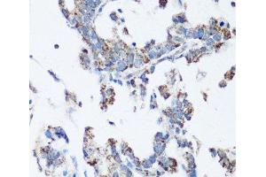 Immunohistochemistry of paraffin-embedded Human gastric cancer using SRC Polyclonal Antibody at dilution of 1:100 (40x lens).