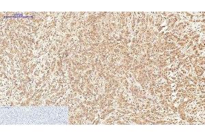 Immunohistochemistry of paraffin-embedded Human breast cancer tissue using XRCC4 Monoclonal Antibody at dilution of 1:200.