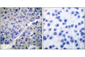 Immunohistochemistry analysis of paraffin-embedded human breast carcinoma, using Synaptotagmin (Phospho-Ser309) Antibody.