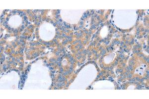 Immunohistochemistry of paraffin-embedded Human thyroid cancer using SLC25A13 Polyclonal Antibody at dilution of 1:35