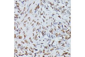Immunohistochemistry of paraffin-embedded human oophoroma using Lamin B1 antibody (ABIN1513160, ABIN3023296 and ABIN3023297) at dilution of 1:100 (40x lens).