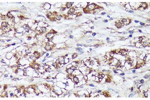 Immunohistochemistry of paraffin-embedded Human liver cancer using MTHFD2 Polyclonal Antibody at dilution of 1:100 (40x lens).