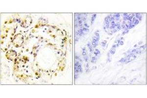 Immunohistochemistry analysis of paraffin-embedded human breast carcinoma, using ERK3 (Phospho-Ser189) Antibody.