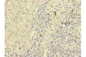 Immunohistochemistry of paraffin-embedded human liver cancer using ABIN7162859 at dilution of 1:100