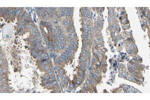 ABIN6274763 at 1/100 staining Human cervical cancer tissue by IHC-P.