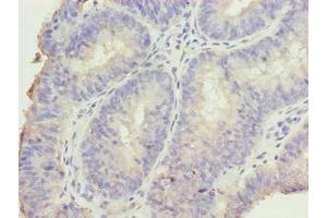 Immunohistochemistry of paraffin-embedded human endometrial cancer using ABIN7165250 at dilution of 1:100