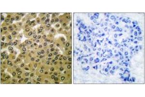 Immunohistochemistry analysis of paraffin-embedded human breast carcinoma, using GSK3 alpha/beta (Phospho-Tyr279/216) Antibody.