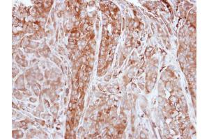 IHC-P Image Immunohistochemical analysis of paraffin-embedded A549 xenograft, using FTL, antibody at 1:500 dilution.