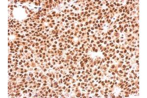 IHC-P Image Immunohistochemical analysis of paraffin-embedded Huh-7 xenograft, using FOXO3A, antibody at 1:500 dilution.
