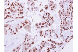 IHC-P Image Immunohistochemical analysis of paraffin-embedded human ovarian cancer, using C/EBP beta, antibody at 1:250 dilution.