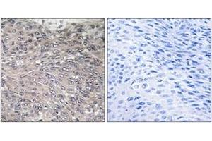 Immunohistochemistry analysis of paraffin-embedded human cervix carcinoma, using Inositol 1, 4, 5-trisphosphate R1 (Phospho-Ser1598/1588) Antibody.