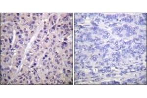 Immunohistochemistry analysis of paraffin-embedded human breast carcinoma, using A-RAF (Phospho-Tyr302) Antibody.