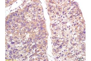 Formalin-fixed and paraffin embedded human lung carcinoma labeled with Anti-S100-A9/MRP14/CFAG/Calgranulin B Polyclonal Antibody, Unconjugated (ABIN749288) at 1:200, followed by conjugation to the secondary antibody and DAB staining