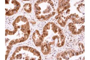 IHC-P Image Immunohistochemical analysis of paraffin-embedded human lung cancer, using CIS, antibody at 1:100 dilution.