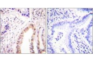 Immunohistochemistry analysis of paraffin-embedded human lung carcinoma, using MEF2D (Phospho-Ser444) Antibody.
