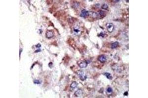 IHC analysis of FFPE human hepatocarcinoma tissue stained with the JNK2 antibody