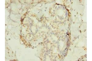 Immunohistochemistry of paraffin-embedded human breast cancer using ABIN7165522 at dilution of 1:100