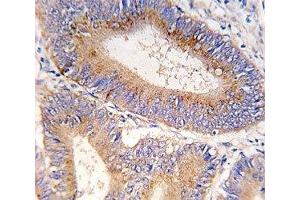 IHC analysis of FFPE human colon carcinoma tissue stained with GDF11 antibody