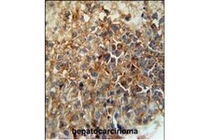 CD46 Antibody (C-term) (ABIN650982 and ABIN2840022) immunohistochemistry analysis in formalin fixed and paraffin embedded human hepatocarcinoma followed by peroxidase conjugation of the secondary antibody and DAB staining.