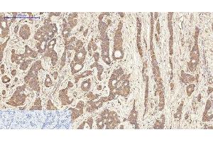 Immunohistochemistry of paraffin-embedded Human liver cancer tissue using AQP4 Monoclonal Antibody at dilution of 1:200.
