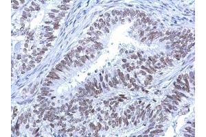IHC-P Image Rad54 antibody [C3], C-term detects Rad54 protein at nucleus on human endometrial carcinoma by immunohistochemical analysis.