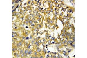 IHC-P: Pleiotrophin antibody testing of human breast cancer tissue