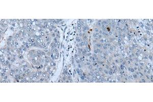 Immunohistochemistry of paraffin-embedded Human liver cancer tissue using NF1 Polyclonal Antibody at dilution of 1:65(x200)