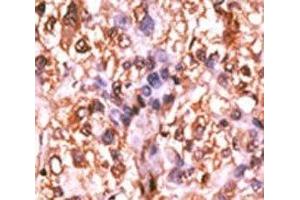 IHC analysis of FFPE human hepatocarcinoma tissue stained with the phospho-Rb antibody.