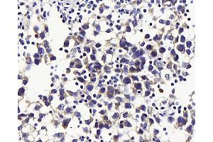Immunohistochemistry analysis of paraffin-embedded human testis cancer using GLUT-3 Polyclonal Antibody at dilution of 1:300.