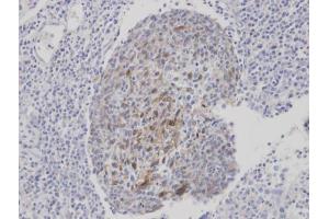 IHC-P Image Immunohistochemical analysis of paraffin-embedded human gastric cancer, using CLCA1, antibody at 1:100 dilution.